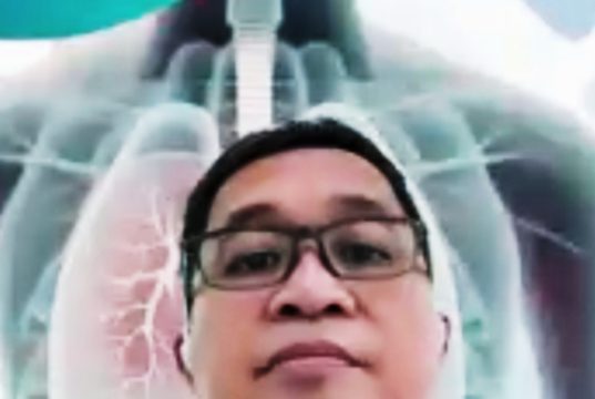 Gebrakan PDPI: Manfaatkan AI Radiologi dan Low-Dose CT Scan untuk Deteksi Kanker Paru